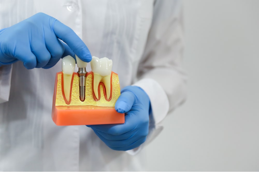 dentist doctor hold a model of teeth with a dental implant