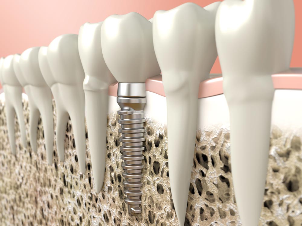 Dental implant Concept