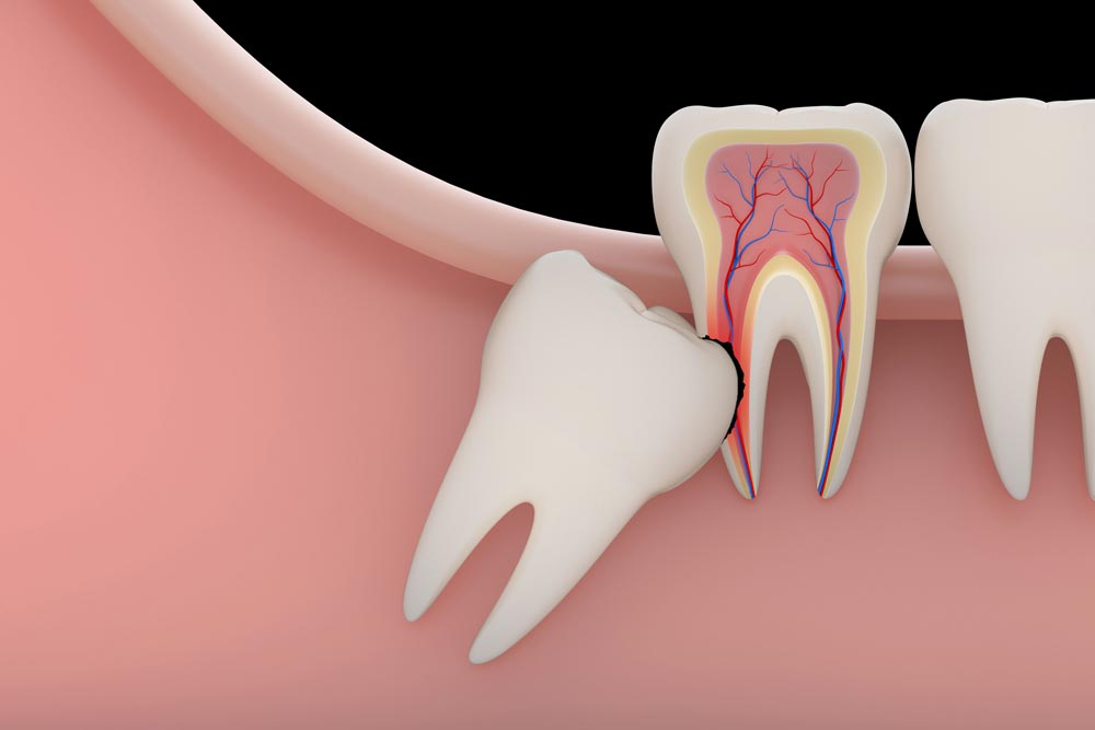 Problems caused by impacted wisdom teeth include