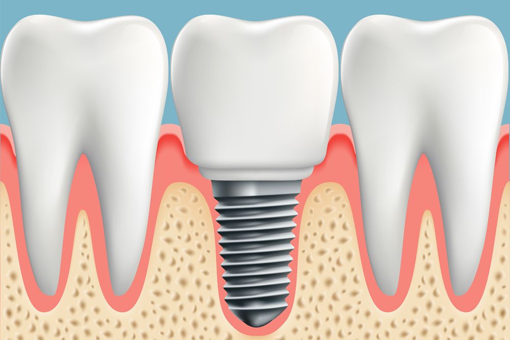 Human teeth and Dental implant