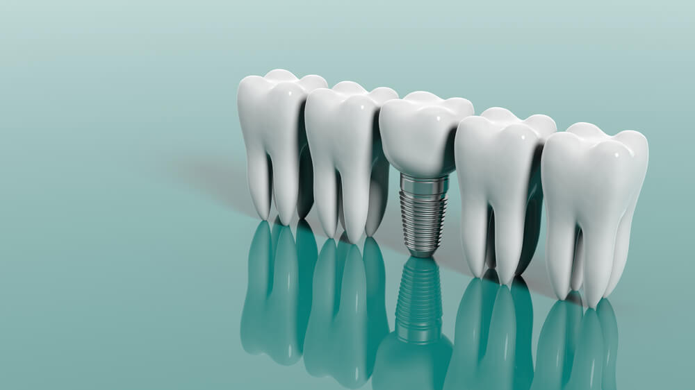 Teeth and dental implant isolated