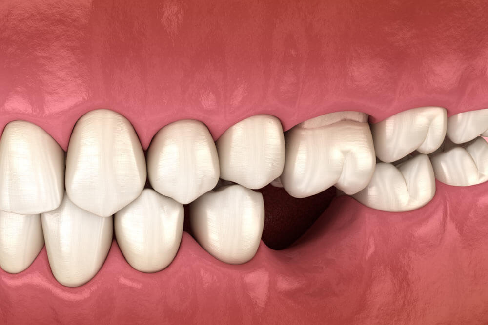 deformatiuon after losing molar tooth